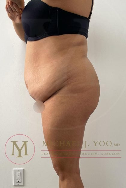 Tummy Tuck Before & After Patient #4253