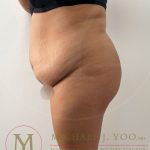 Tummy Tuck Before & After Patient #4253