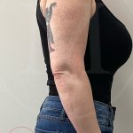 Arm Liposuction Before & After Patient #4292