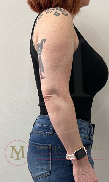 Arm Liposuction Before & After Patient #4292