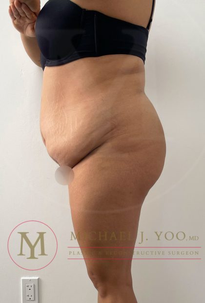 Tummy Tuck Before & After Patient #4253