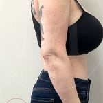 Arm Liposuction Before & After Patient #4292