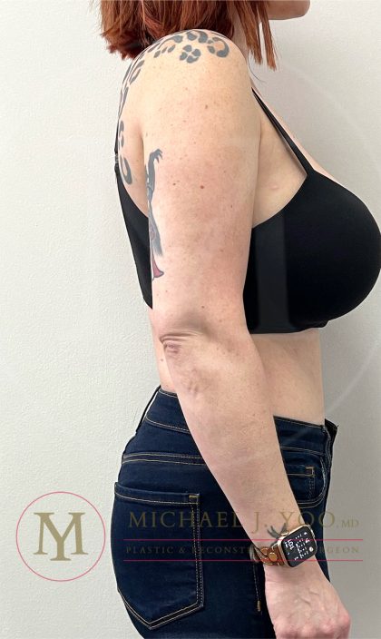 Arm Liposuction Before & After Patient #4292