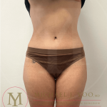 Tummy Tuck Before & After Patient #4240