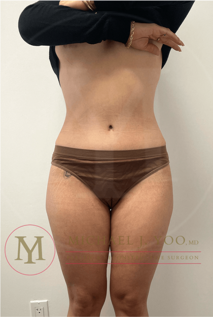 Tummy Tuck Before & After Patient #4240