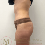 Tummy Tuck Before & After Patient #4240