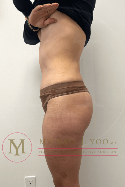 Tummy Tuck Before & After Patient #4240