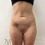 Tummy Tuck Before & After Patient #4240