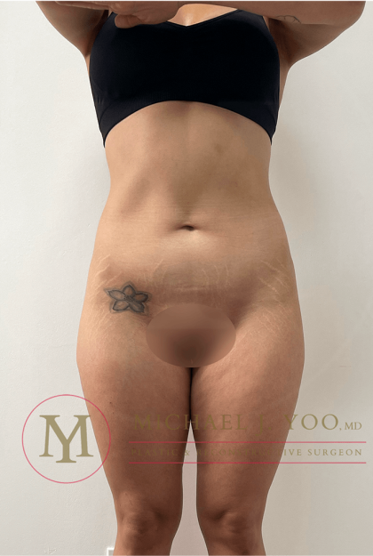 Tummy Tuck Before & After Patient #4240