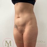 Tummy Tuck Before & After Patient #4240