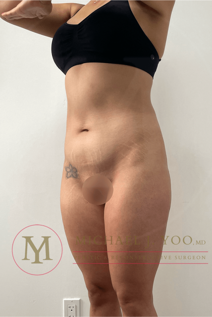 Tummy Tuck Before & After Patient #4240