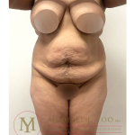 Tummy Tuck Before & After Patient #4293