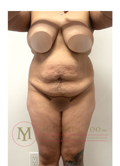 Tummy Tuck Before & After Patient #4293