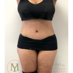 Tummy Tuck Before & After Patient #4293