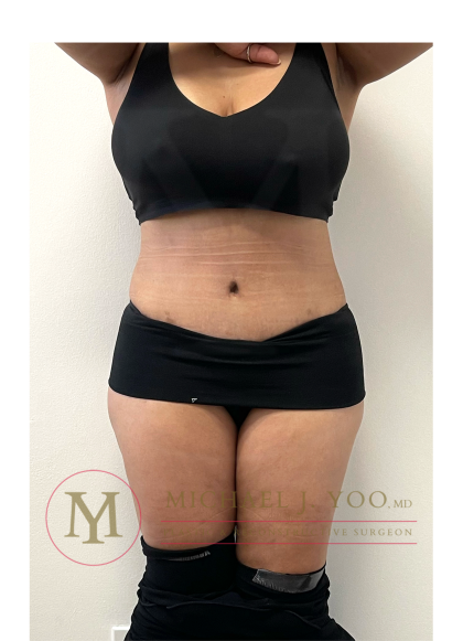 Tummy Tuck Before & After Patient #4293