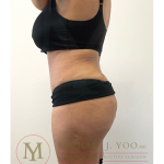 Tummy Tuck Before & After Patient #4293