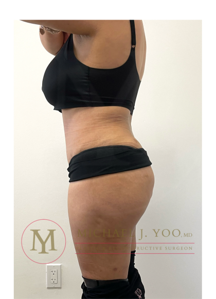 Tummy Tuck Before & After Patient #4293