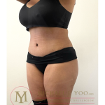 Tummy Tuck Before & After Patient #4293