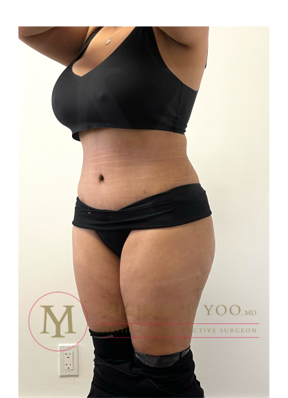 Tummy Tuck Before & After Patient #4293