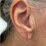 Earlobe Repair Before & After Patient #4358