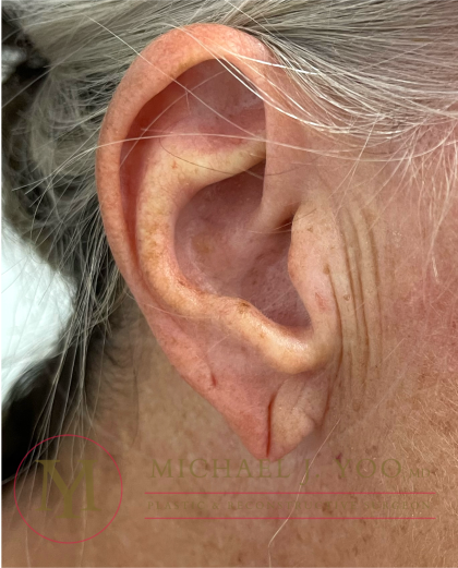 Earlobe Repair Before & After Patient #4358