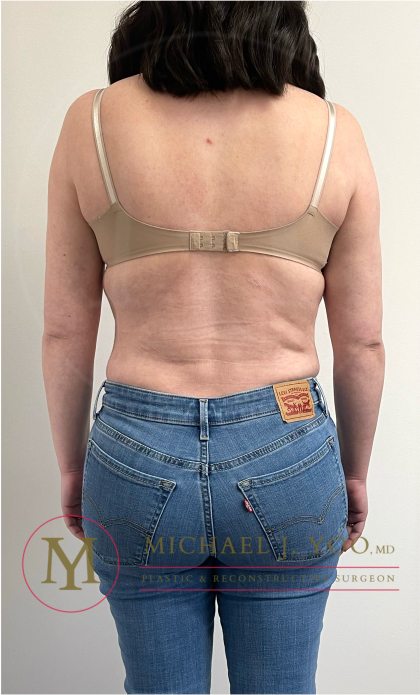 Arm Liposuction Before & After Patient #4339