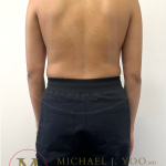 Arm Liposuction Before & After Patient #4338