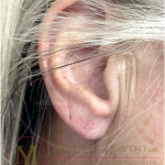 Earlobe Repair Before & After Patient #4358