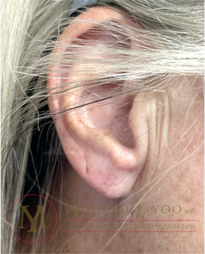 Earlobe Repair Before & After Patient #4358