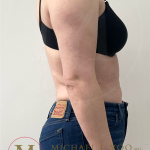 Arm Liposuction Before & After Patient #4339