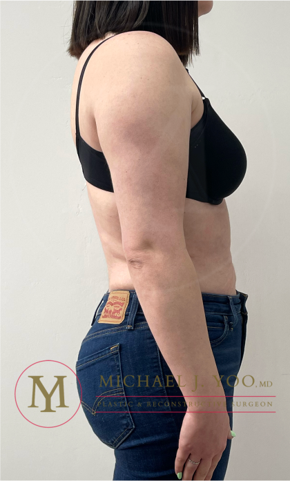 Arm Liposuction Before & After Patient #4339