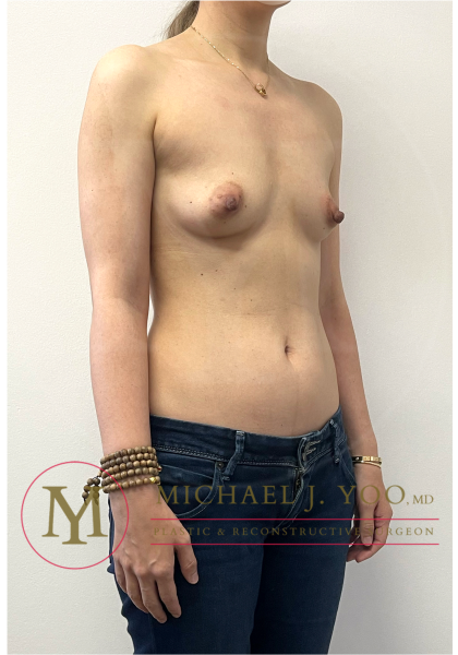 Breast Augmentation Before & After Patient #4330