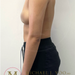 Arm Liposuction Before & After Patient #4338