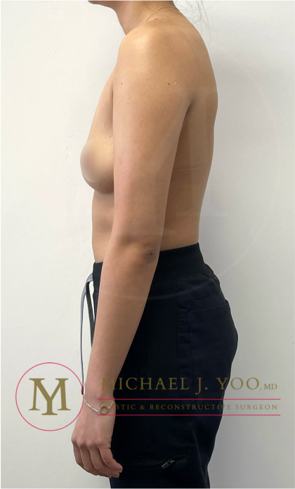 Arm Liposuction Before & After Patient #4338