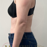 Arm Liposuction Before & After Patient #4339