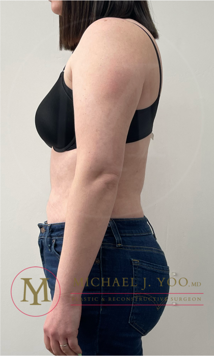 Arm Liposuction Before & After Patient #4339