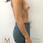 Breast Augmentation Before & After Patient #4323