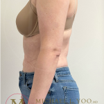 Arm Liposuction Before & After Patient #4339