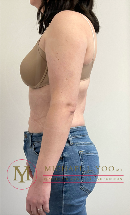 Arm Liposuction Before & After Patient #4339