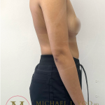 Arm Liposuction Before & After Patient #4338