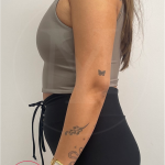 Arm Liposuction Before & After Patient #4337