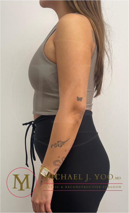 Arm Liposuction Before & After Patient #4337