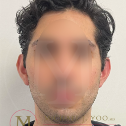 Otoplasty Before & After Patient #4375