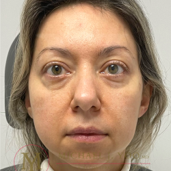 Lower Eyelid Lift Before & After Patient #4365