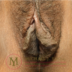 Labiaplasty Before & After Patient #4400