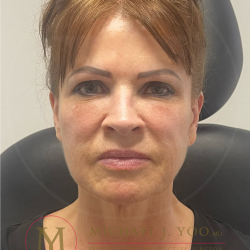 Facelift & Neck Lift Before & After Patient #4398