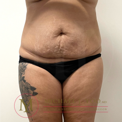 Tummy Tuck Before & After Patient #4380
