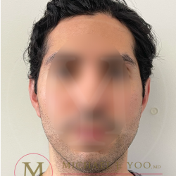 Otoplasty Before & After Patient #4375