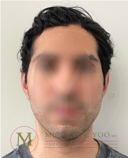 Otoplasty Before & After Patient #4375