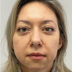 Lower Eyelid Lift Before & After Patient #4365